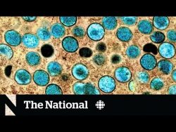 Monkeypox cases spreading across Canada