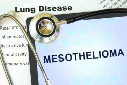 Mesothelioma: Definition, symptoms and types